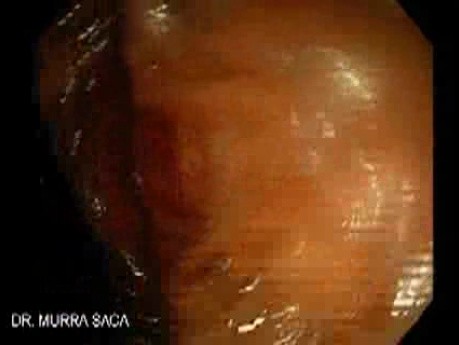 Upper GI Bleeding Due to Esophageal Varices - Closer Look at the Fibrin Plug