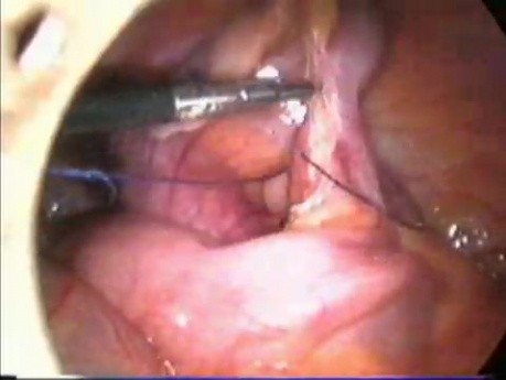 Laparoscopic appendectomy
