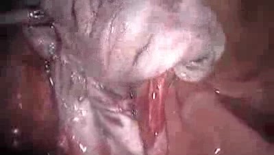 Laparoscopic Cystectomy