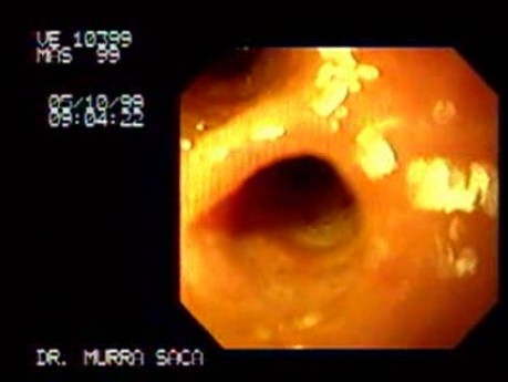 Choledochoduodenostomy
