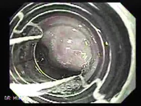 Ligation of Esophageal Varices - Beginning of the Treatment