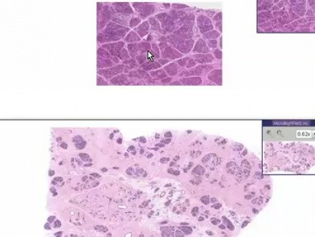Hyperplasia of lactation - Histopathology - Breast