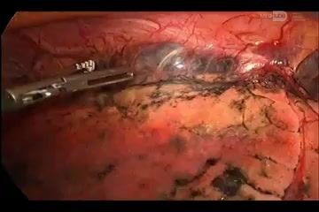 Thoracoscopic Biopsy