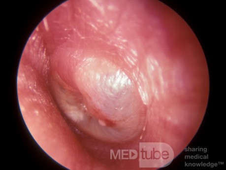Severe Acute Otitis Media Which Has Drained Spontaneously 1 Hour Later
