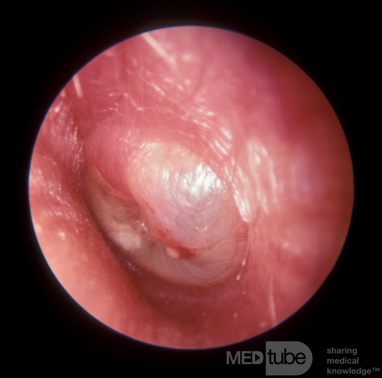 Severe Acute Otitis Media Which Has Drained Spontaneously 1 Hour Later