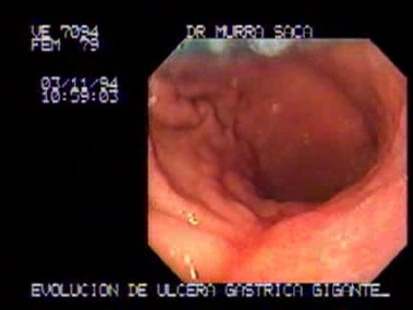 Large Ramified Ulcer of the Stomach (3 of 3)