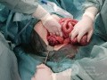 Ischemic Colitis