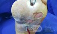 Diabetic Foot Ulcer with Infection 