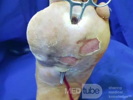 Diabetic Foot Ulcer with Infection 
