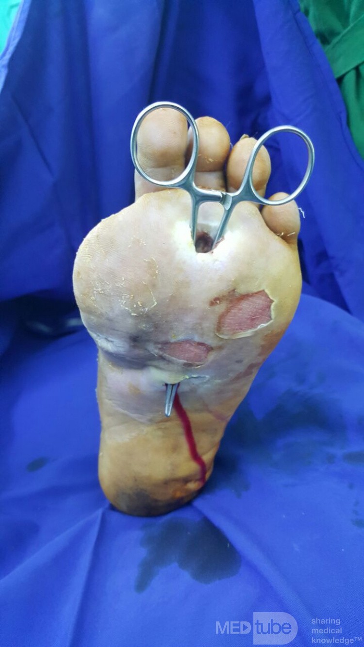 Diabetic Foot Ulcer with Infection 