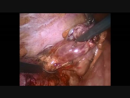 Laparoscopy During Pregnancy