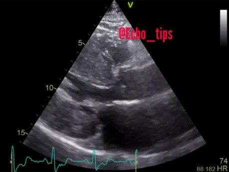 5. Echocardiography Case - What You See?