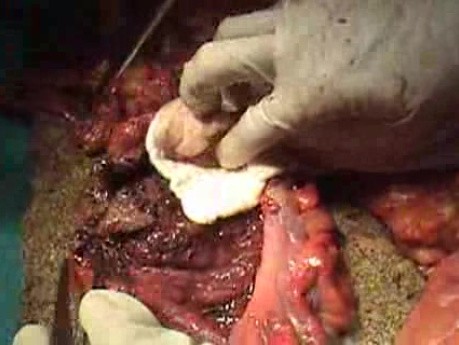 Multiple Rectal Ulcers (56 of 110)