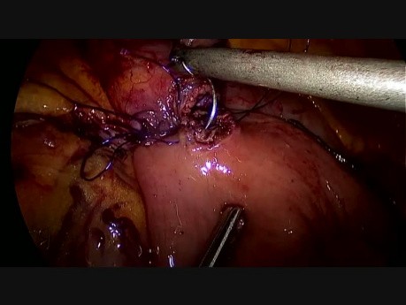 Gastric Bypass with Hand Sewn Pouch-Jejunal Anastomosis