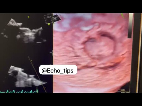 Prospective 3D Transesophageal Echocardiography (TEE) of Mitral Valve and Left Atrium