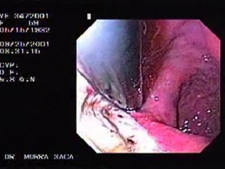 Ulcer of Gastric Fundus
