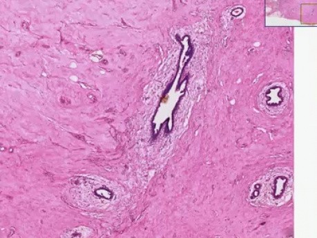 Gynecomastia - Histopathology - Breast