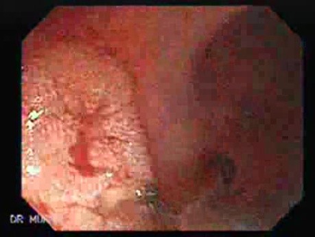 Familial Adenomatous Polyposis (22 of 36)