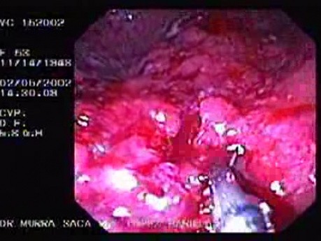 Severe Case Of Ulcerative Colitis (5 of 6)