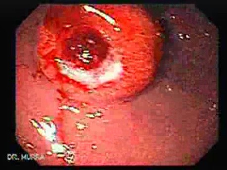 Gastrointestinal Stromal Tumor - GIST (3 of 65)