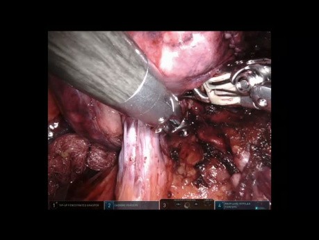 Anatomic Segmentectomy Lung Surgery