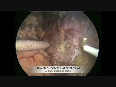 Left Adrenalectomy For Cushing's Disease