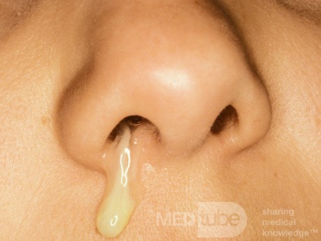 Bacterial Sinusitis