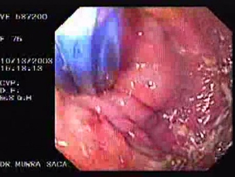 Esophageal Achalasia - Endoscopic Maneuvers