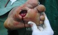 Diabetic foot ulcer - neuropathic -associated with ostemyelitis 