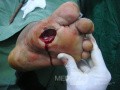 Diabetic foot ulcer - neuropathic -associated with ostemyelitis 