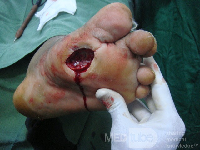 Diabetic foot ulcer - neuropathic -associated with ostemyelitis 