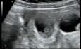 Transvaginal Fetal Reduction of a Twin Within a One Sac Quadruplet Pregnancy