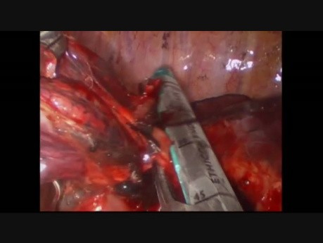 Uniportal VATS Left Upper Anatomic Segmentectomy S2 S4-5