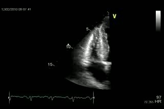 Amyloidosis Of The Heart And Hypertrophic Right Ventricular