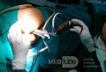 Trans Anal Endoscopic Operation for A Large Villous Adenoma