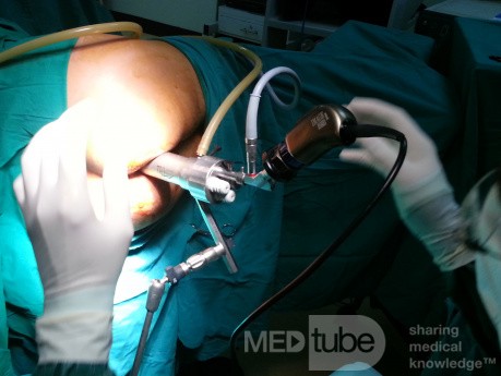 Trans Anal Endoscopic Operation for A Large Villous Adenoma