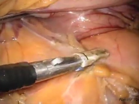  Laparo-Endoscopic Single Site (LESS) Distal Pancreatectomy and Splenectomy with an Extraction Port