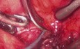Laparoscopic Bladder Neck Reconstruction Using Buccal Mucosal Graft