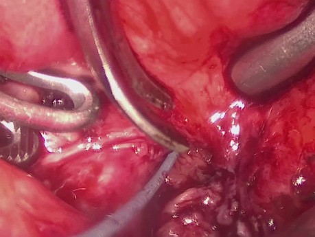Laparoscopic Bladder Neck Reconstruction Using Buccal Mucosal Graft