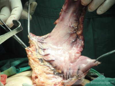 Gastric Ulcerated Adenocarcinoma of the Pre-pyloric Antrum (16 of 28)