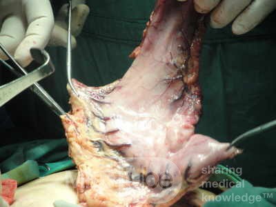 Gastric Ulcerated Adenocarcinoma of the Pre-pyloric Antrum (16 of 28)