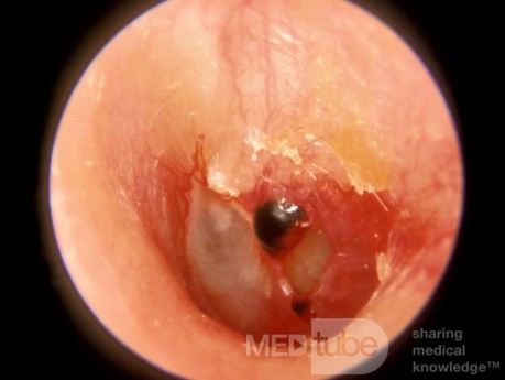 Traumatic Perforation [3 days old]