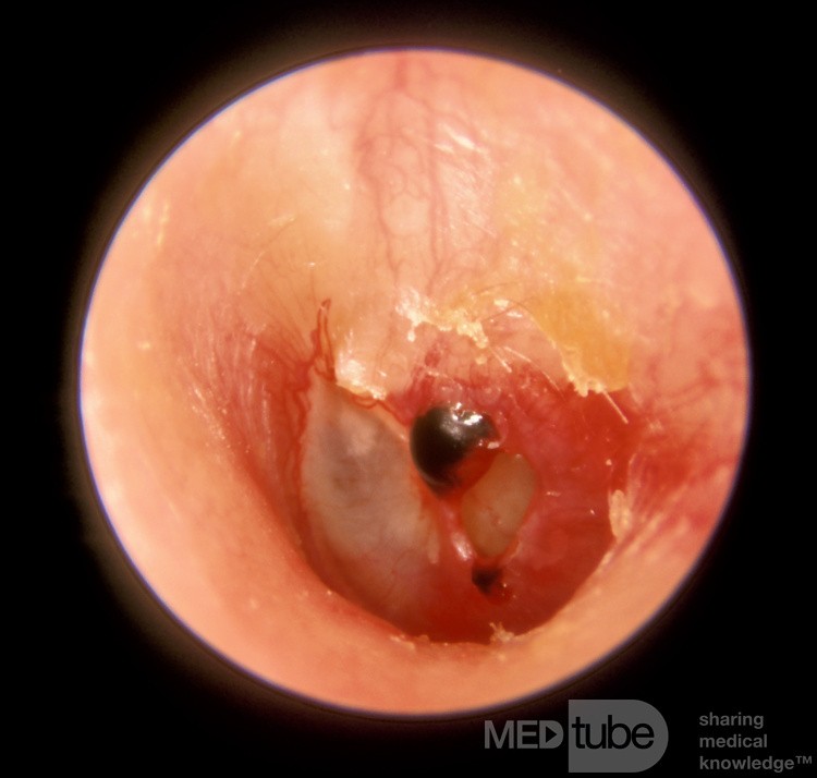 Traumatic Perforation [3 days old]