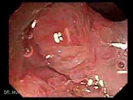 Giant Tubulo - Villous Adenoma (7 of 17)