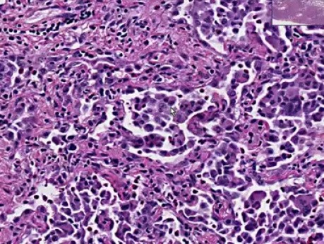 Desquamative interstitial pneumonia