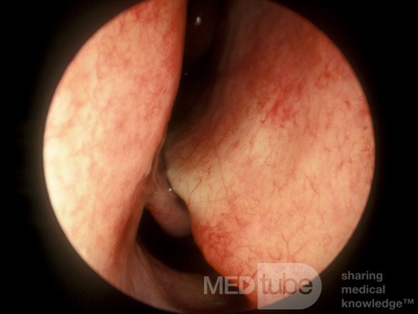 Severely Deviated Nasal Septum