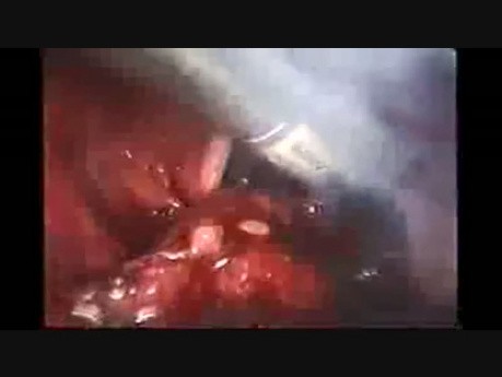 Laparoscopic Pelvic Lymphadenectomy