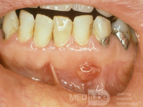 Root Abscess and Granuloma