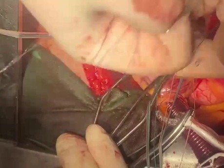 Mitral Valve Replacement in Patient with MS and MR 