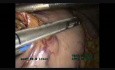 Laparoscopic/Thoracoscopic Esophagectomy